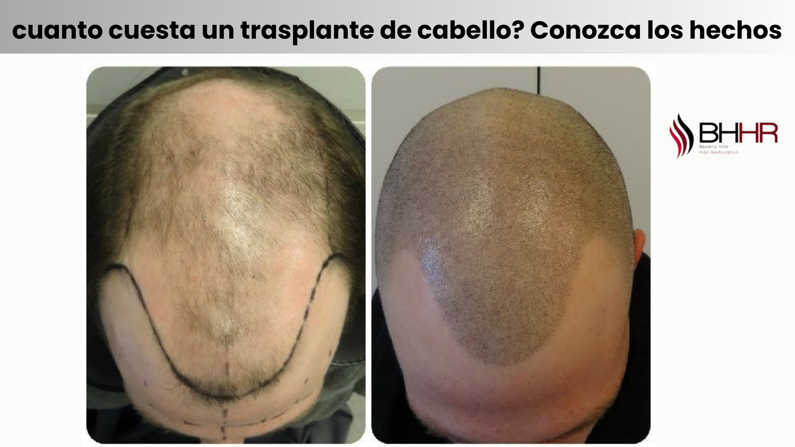 cuanto cuesta un trasplante de cabello