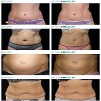 affordable male and female face sculpting in Long Island NY